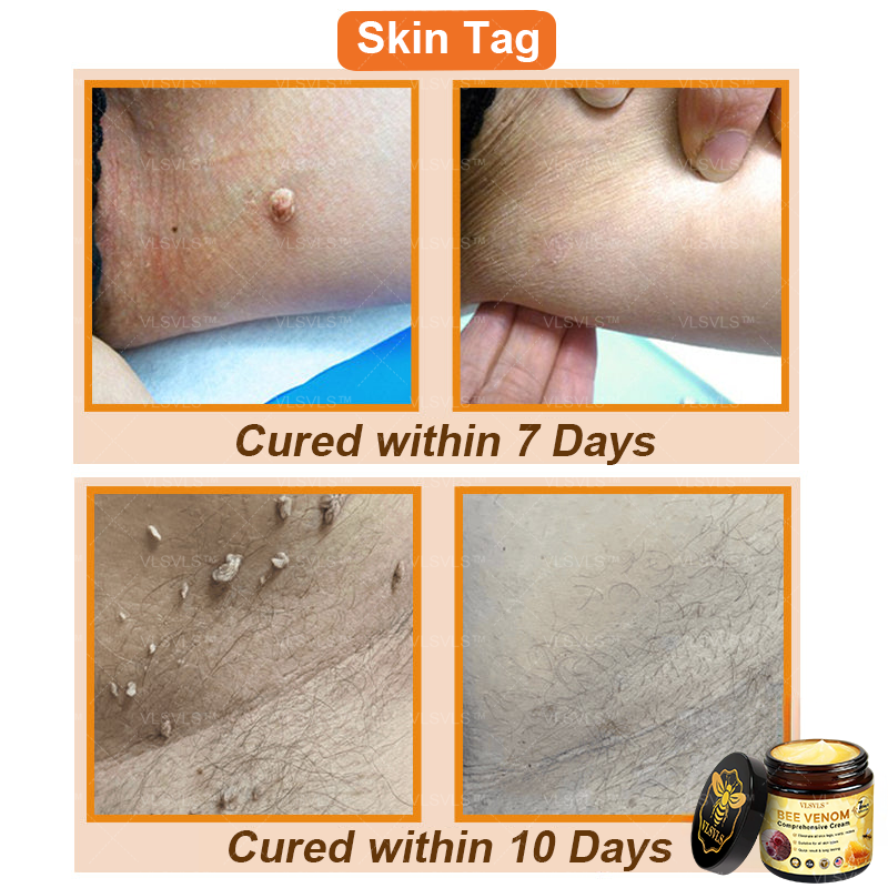 VLSVLS™ Bee Venom Comprehensive Cream 🔥🔥(Suitable for all ages & AAD recommends)