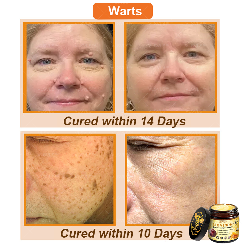 VLSVLS™ Bee Venom Comprehensive Cream 🔥🔥(Suitable for all ages & AAD recommends)